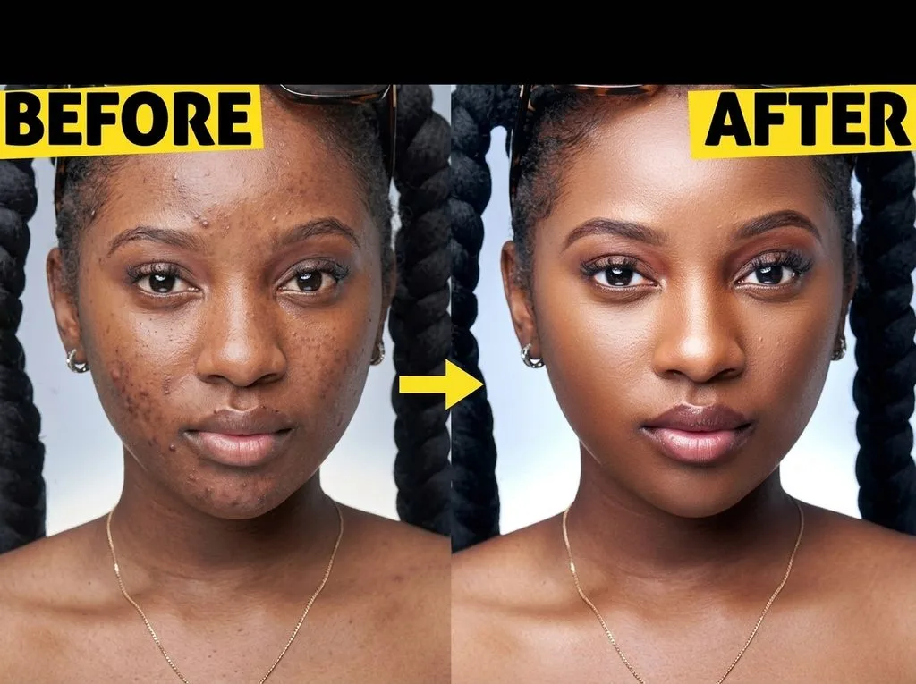 Before (left, acne and uneven skin) and after (right, smooth glowing skin with natural texture) full portrait retouching comparison